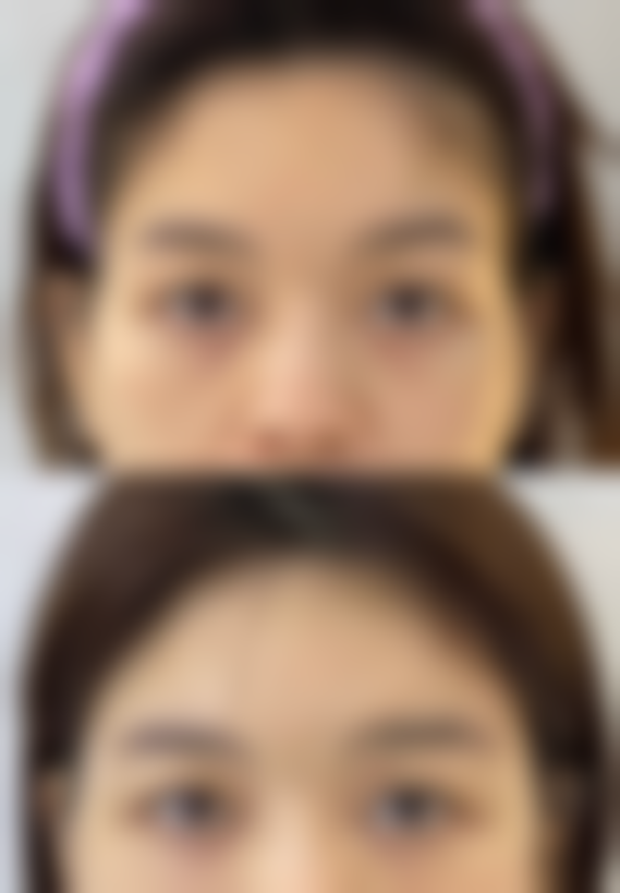 假体隆胸有积液一般多久可以吸收？解密恢复过程中的关键时间点！吸收时间受哪些因素影响？ 