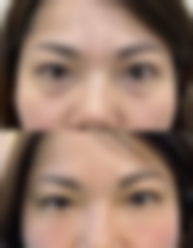 缝针后该如何进行术后护理?