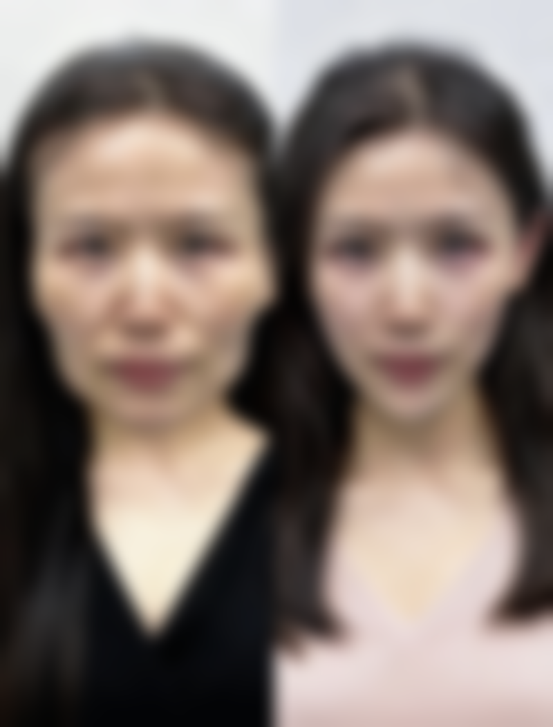 做完眼袋多久恢复正常？揭秘恢复期的真实情况与护理要点！恢复时间受哪些因素影响？ 