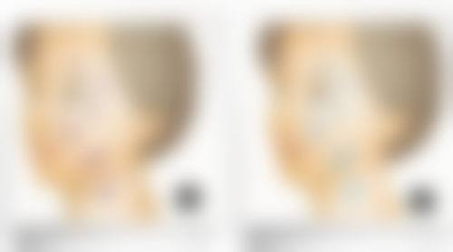 六问：点阵激光治疗对什么样的疤痕疙瘩有成效，原理和疗程是怎样的？