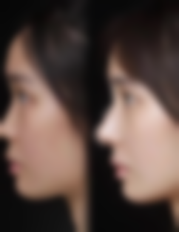 防止留疤痕饮食上有哪些禁忌呢？