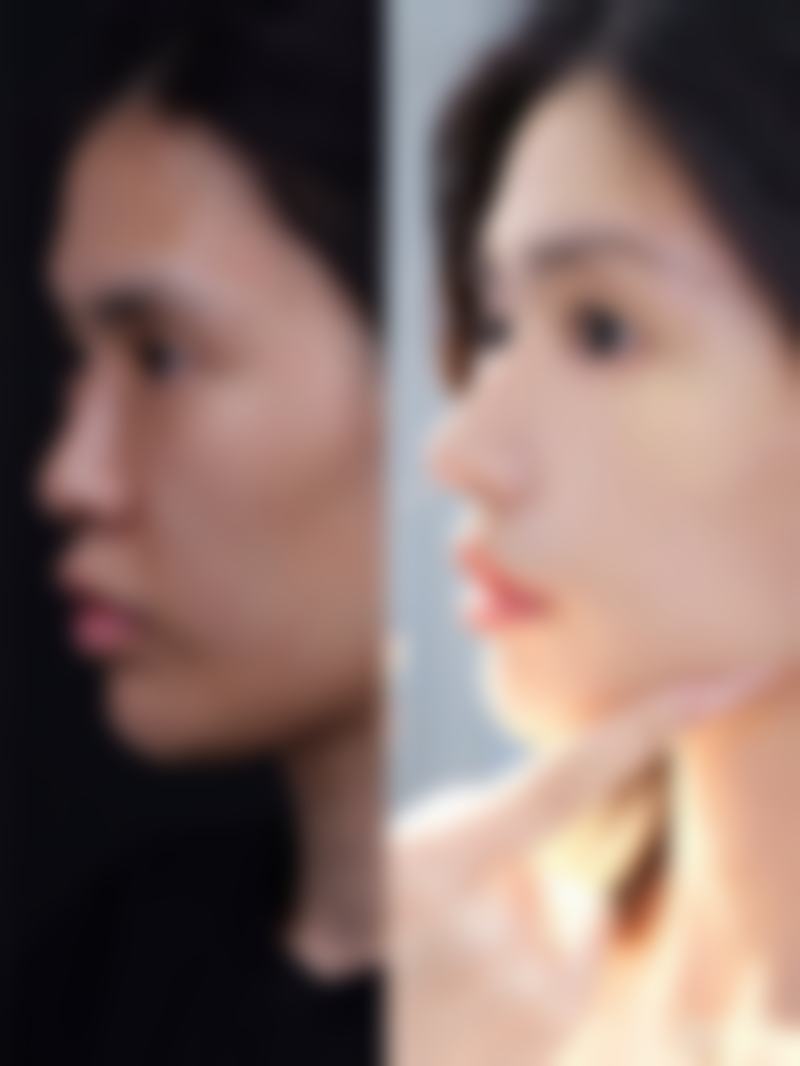 家长在小孩割双眼皮这件事上，需要重点关注什么呢？