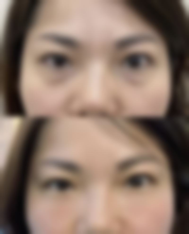 射频微针修复植皮疤痕的相关情况如何？