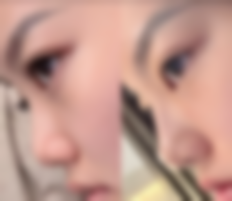 维生素E油可以用于手术疤痕吗？