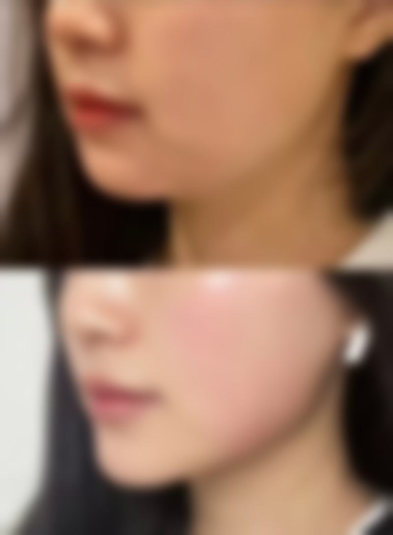 局部药物治疗去除耳洞疤痕疙瘩成效好吗？