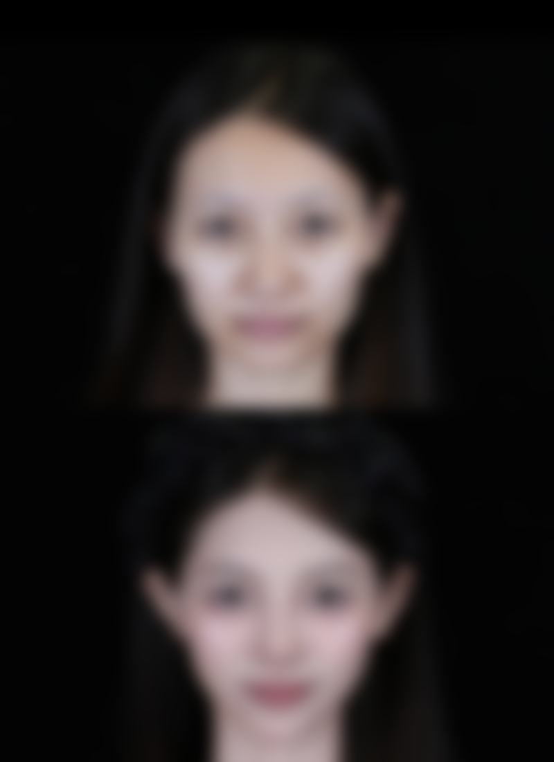 内窥镜隆胸是什么意思？揭秘这项技术的安全性与效果！它适合哪些人群且恢复时间长吗？ 