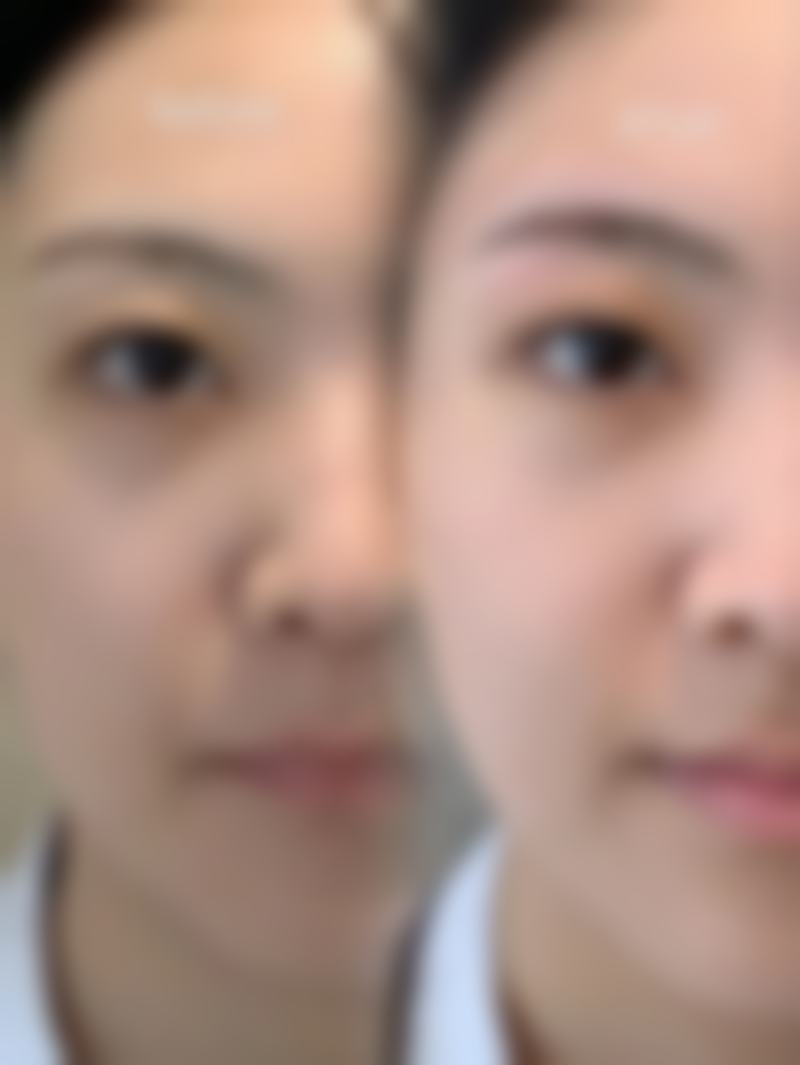 提眉去眼袋手术的成效如何?