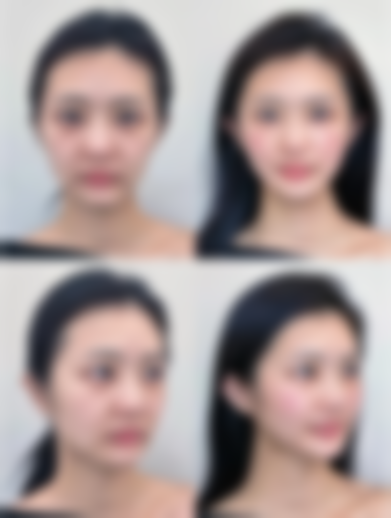 去眼袋手术有哪些风险及注意事项?