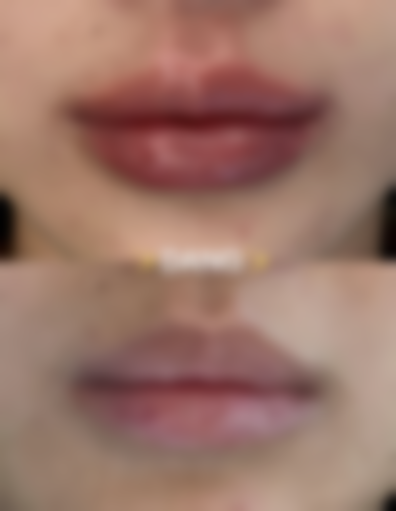 遇到20年以上的凹陷疤痕问题该怎么办呢?