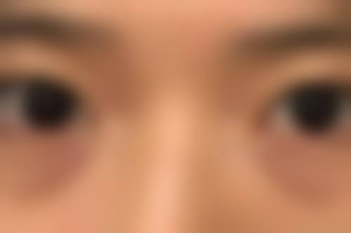 全切双眼皮眼睛闭不严多久能恢复？专家告诉你恢复过程中的注意事项，如何促进快速恢复？ 