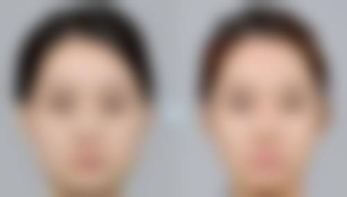 正规医院打除皱针有什么优势？