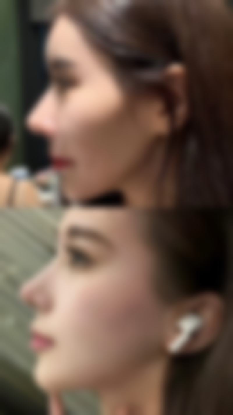 特殊情况下眼袋抽脂的修复时间有什么不同？