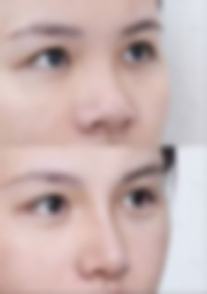 眼袋抽脂术后有哪些护理要点？