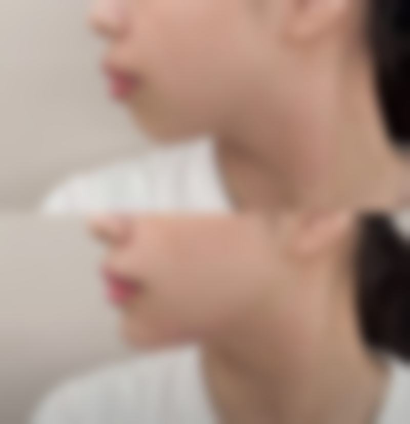 含钾和维生素的果蔬是如何助力割双眼皮后消肿的？