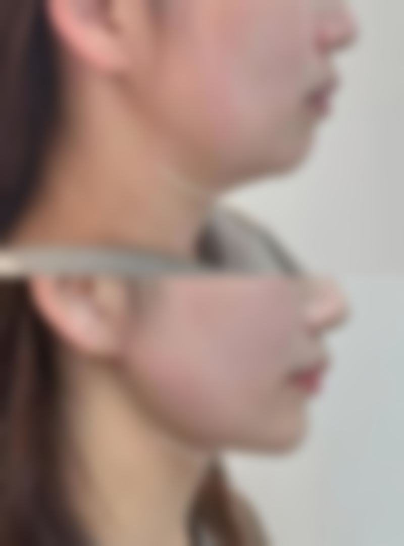 不同隆鼻方式在侧睡时间上有特殊情况吗？