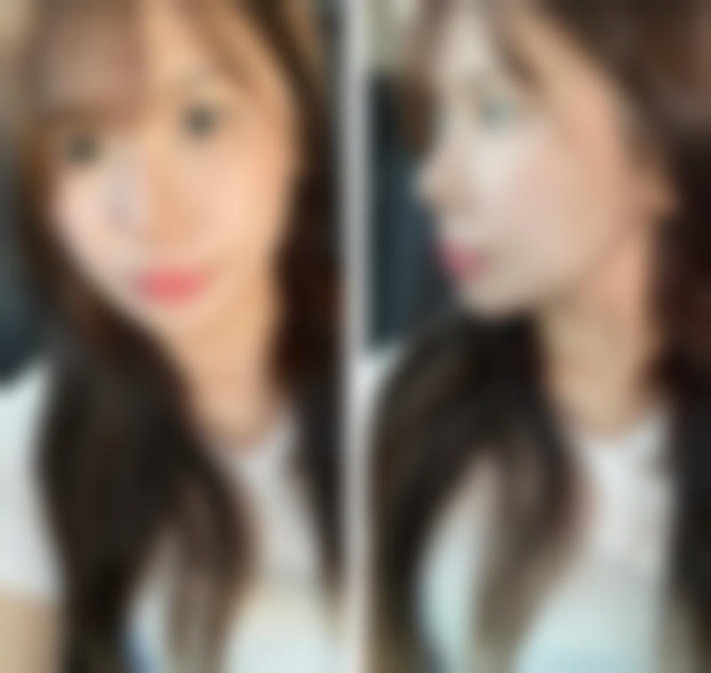 小眼睛做完双眼皮手术后，医院能提供哪些帮助？