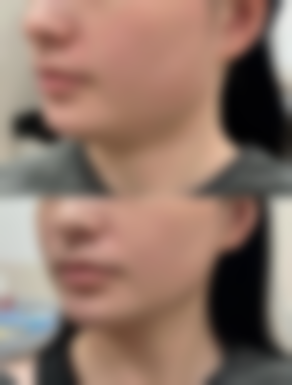 术后30天以上睡觉姿势就没限制了吗？