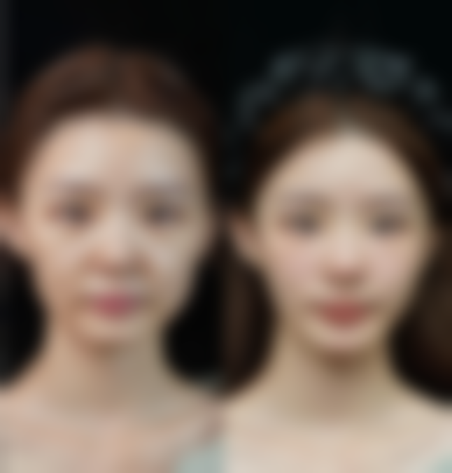 东莞安美医疗美容门诊部蔡泽翔医生自体脂肪丰胸技术怎么样？