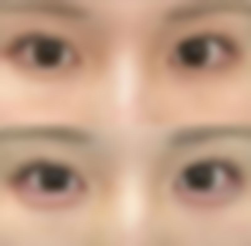 局部护理有哪些方法可以缓解小孩眼袋大？