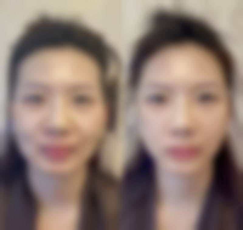 双眼皮手术后成效多久能稳定？