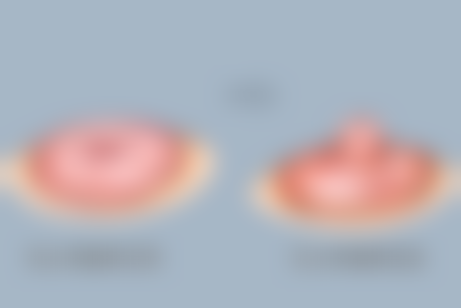 术后早期站立时间应该怎么控制?