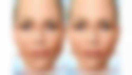 中重度滑动（伴脂肪膨出）有什么办法？