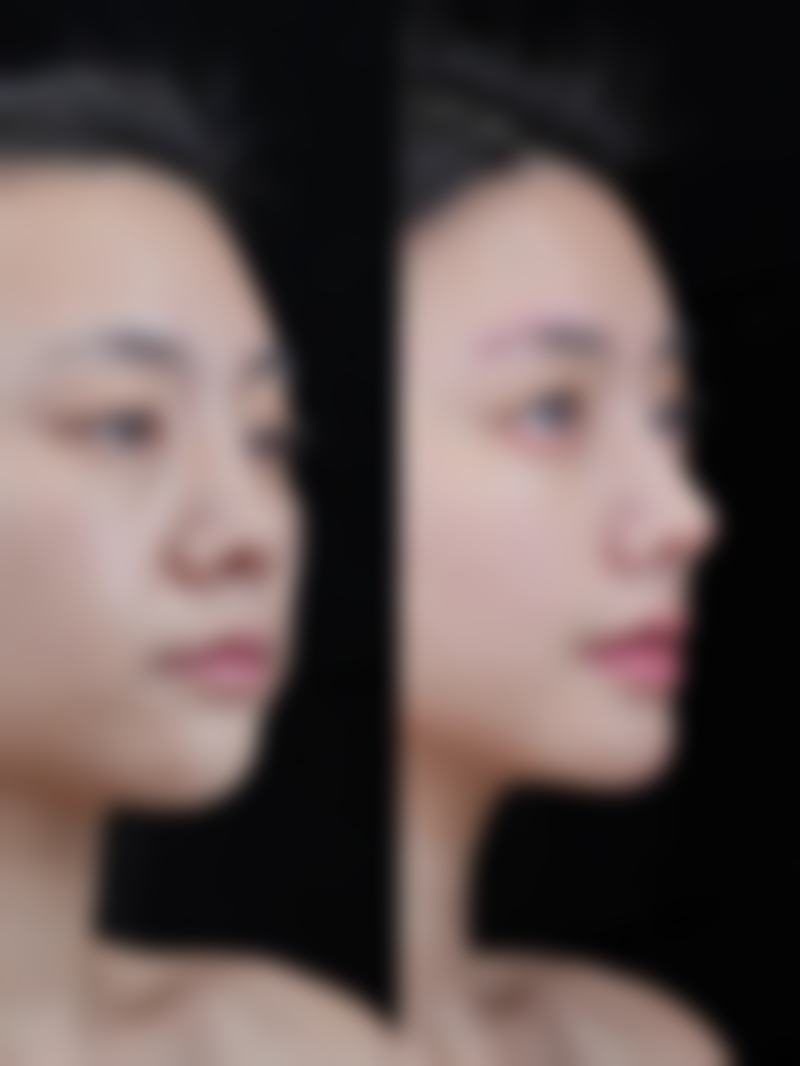 东莞安美医疗美容门诊部蔡泽翔医生自体脂肪丰胸技术怎么样？