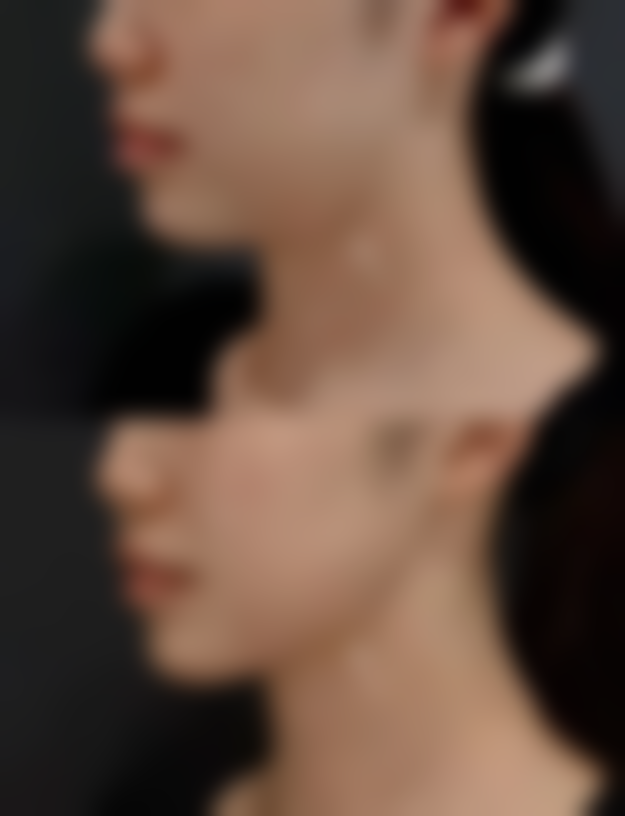 如果双眼皮变浅了,该怎么办呢?