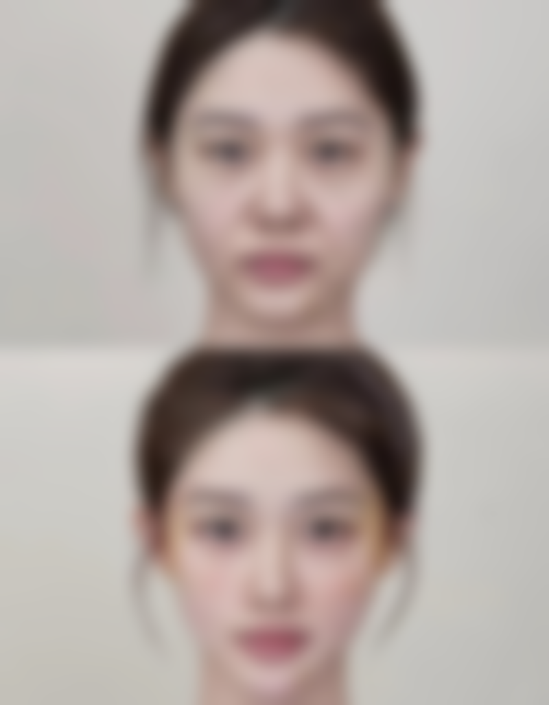 方法二：同位素治疗，抚平疙瘩有奇效？