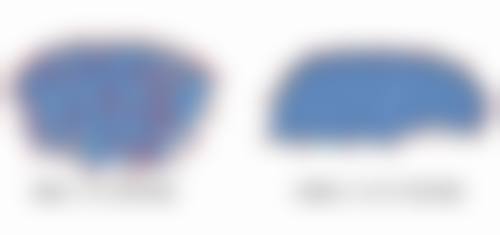 手术切除眼袋(内切法、外切法、眶隔释放术)分别适合哪些人?有什么特点?