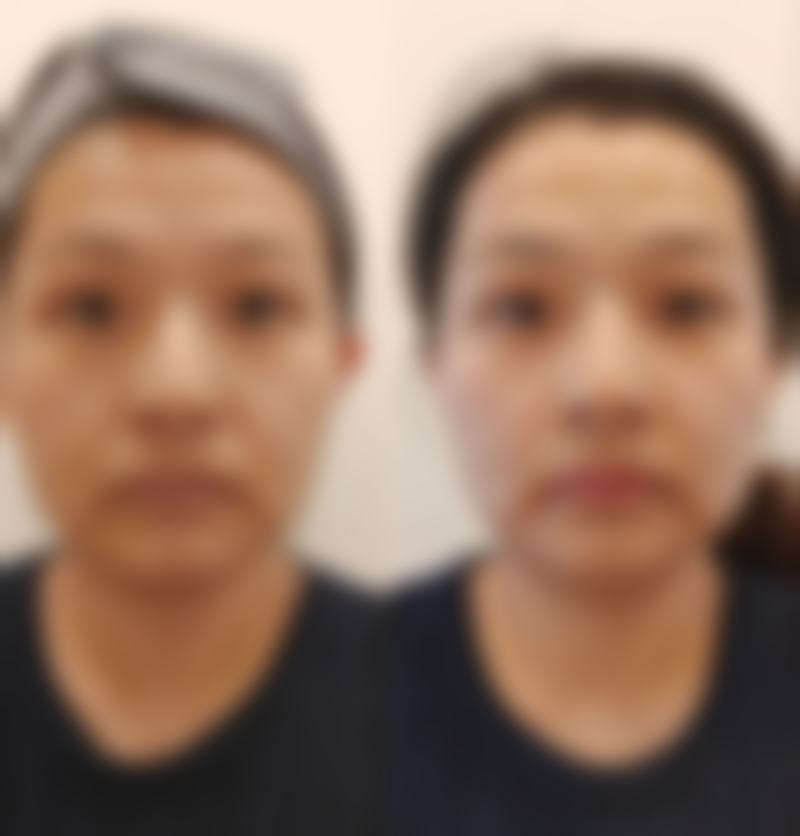 不同术式(内切法、外切法、射频/激光)在安心性等方面有什么对比?