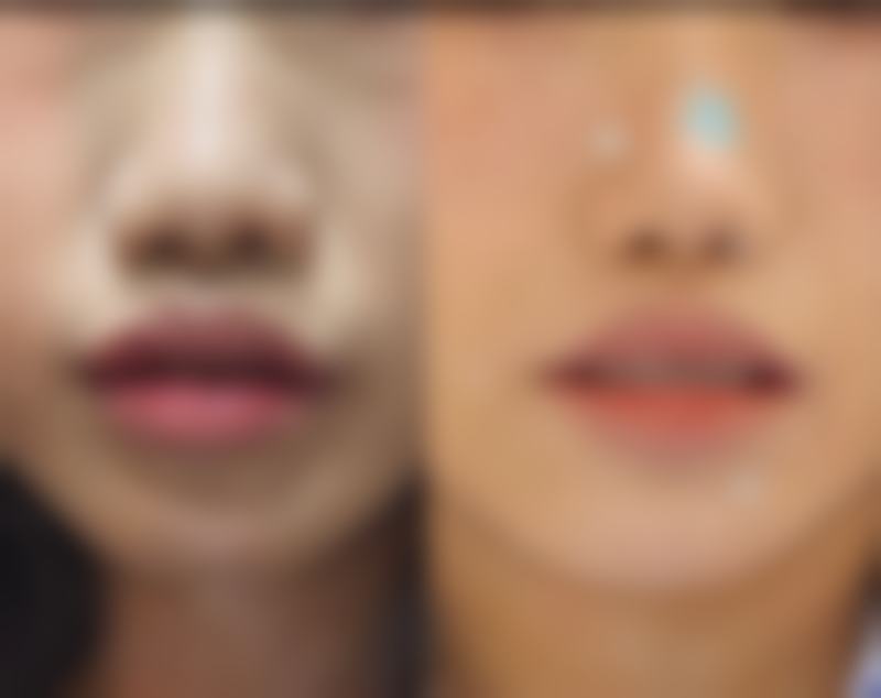 割双眼皮会加速老化吗？揭秘手术背后的真实影响与护理秘诀！答案是一般不会，术后护理好还能延缓眼部衰老！ 