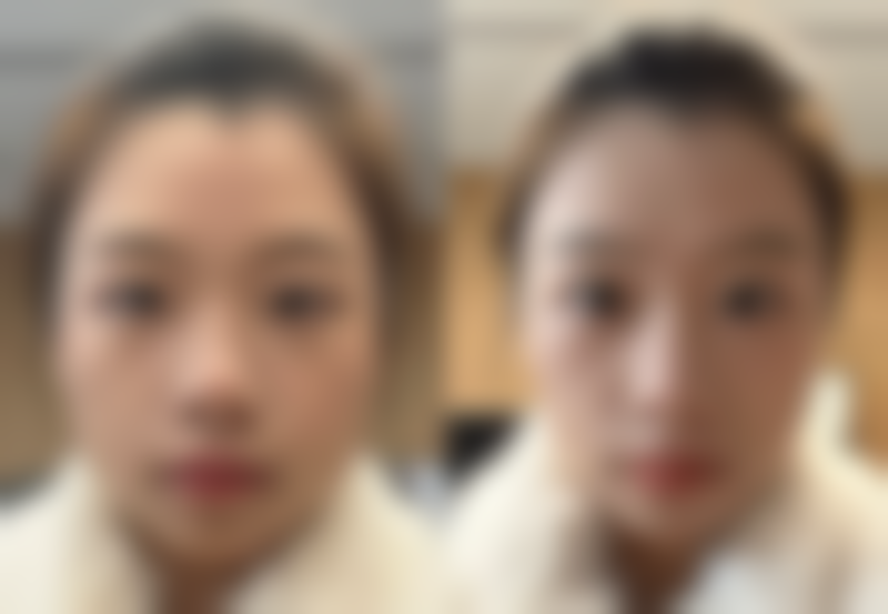 定点双眼皮（韩式三点）是怎样的一种方法呢？