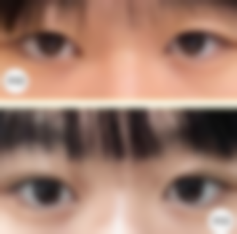 术后水肿期（术后48小时）需要怎么护理呢？