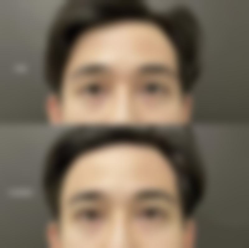 头发种植技术成熟吗?