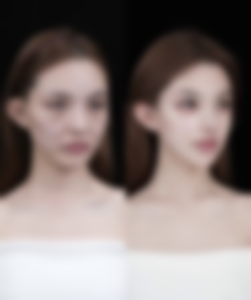 膨体加肋软骨隆鼻有什么风险呢?