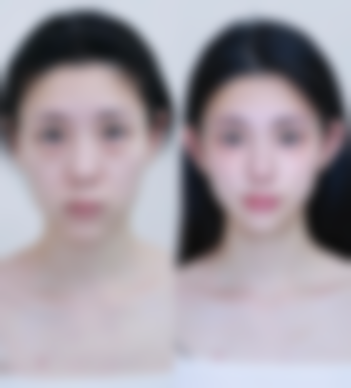 和去眼袋手术相比,黛元堂去眼袋产品修复时间有什么不同呢?