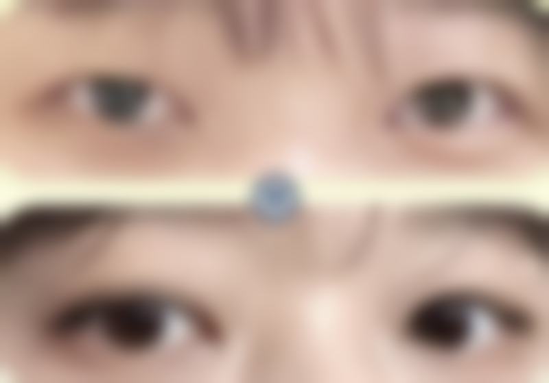 有哪些不推荐的治疗小孩眼袋和黑眼圈的方式呢？