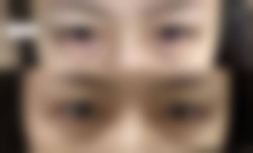 激光去眼袋是优选吗？