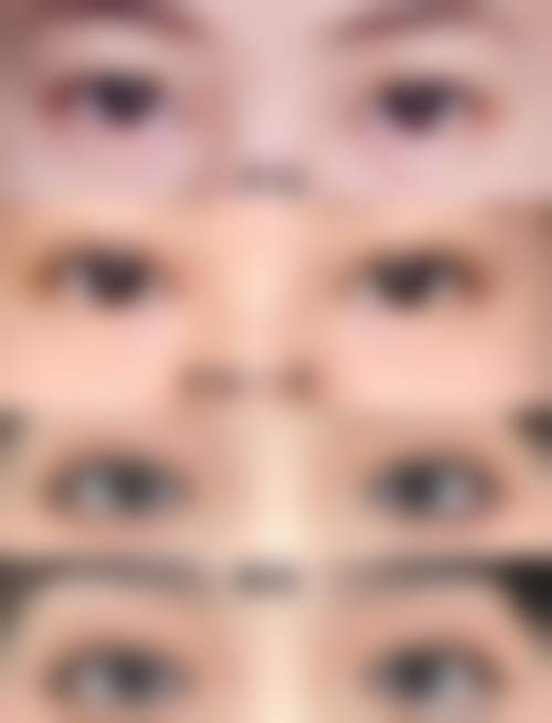 上海申江医院整形美容科王玉如医生眼部整形技术怎么样?