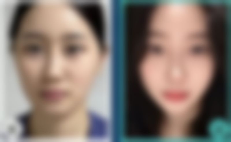 广州大麦微针植发正规吗？