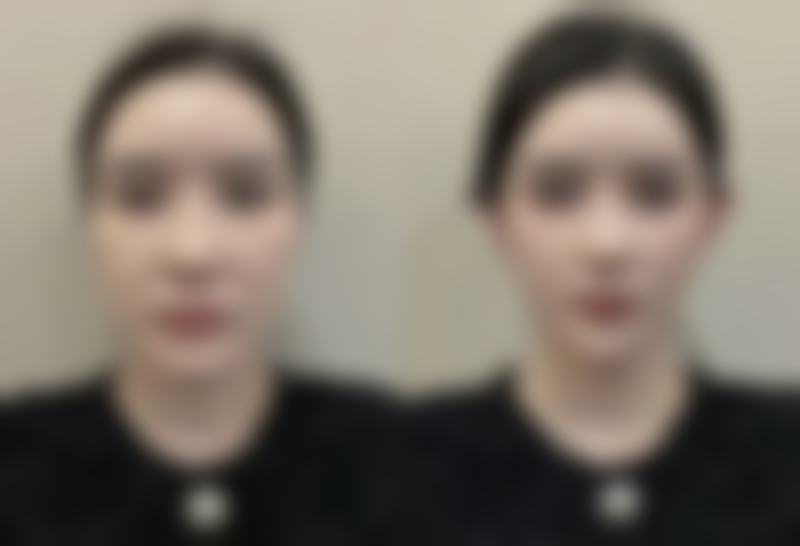 东莞华美医疗美容王德超医生眼部整形技术怎么样?