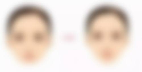 不同手术方式适合哪些人群?修复周期是多久?