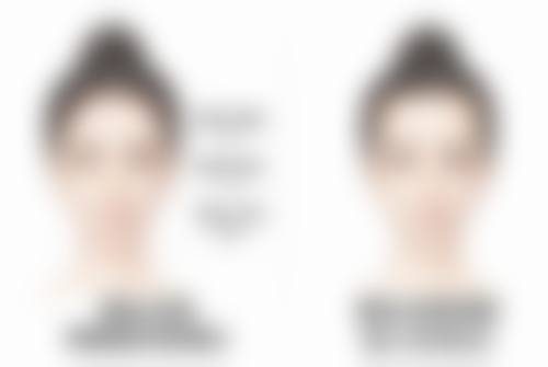 双眼皮拆线后有残留线头,术后护理有哪些要点呢?