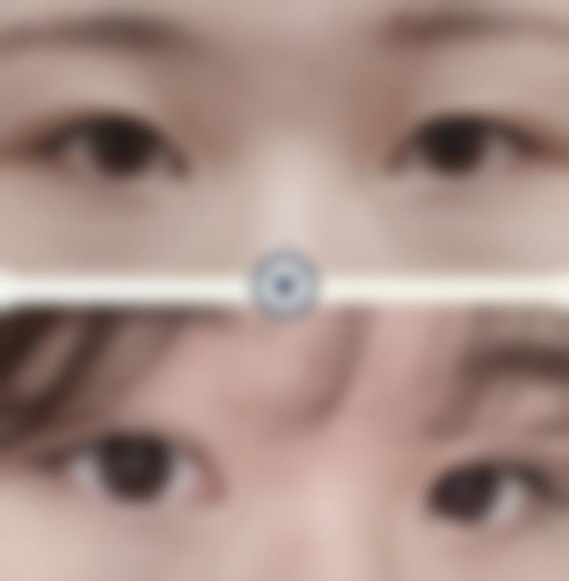 怎样才能改善眼袋泪沟？方法四：生活干预与日常护理