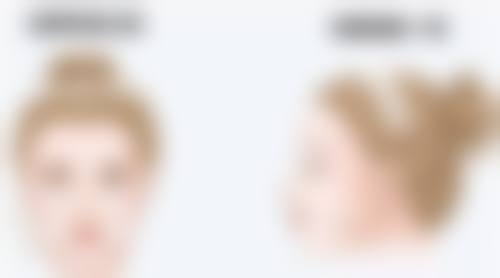 哪些情况下鼻尖白点需要治疗或干预？