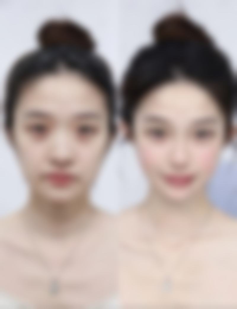 隆鼻后如何观察鼻尖皮肤血供？