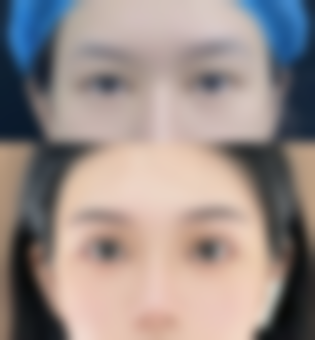 术后不同阶段有哪些活动限制和护理重点?