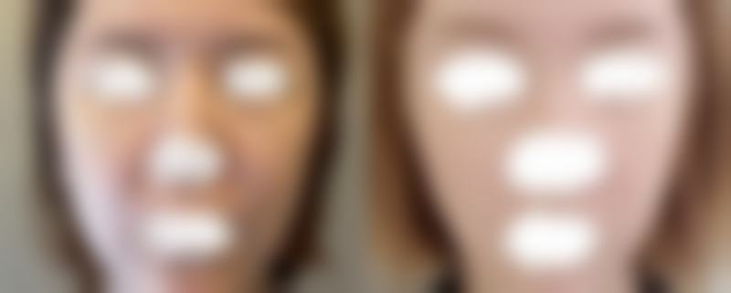 不同类型的眼袋该如何应对?