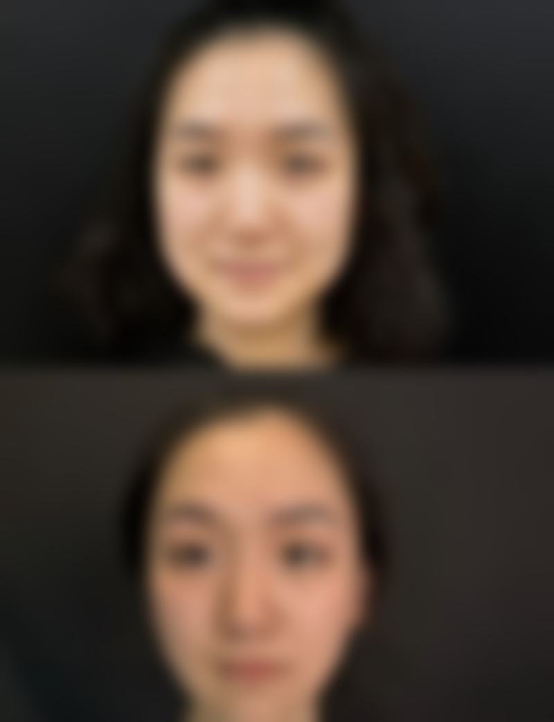 祛痣疤痕修复有哪些注意事项?